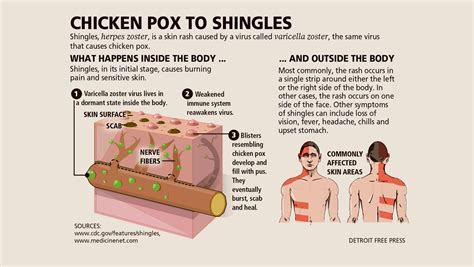 What You Need To Know About Shingles Infections