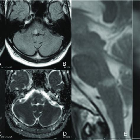 Mr Images Show Right Medial Pontomedullary Junctional Infarction Each