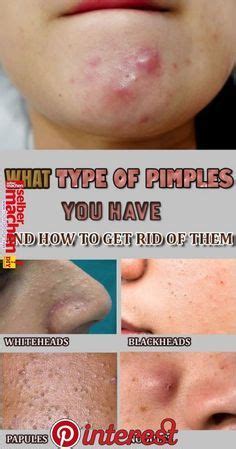 Sandalwood proves soothing to irritated skin and acts as a natural antiseptic, which can aide in scar healing. How To Get Rid Of Pimple Scabs - Natural Remedies And ...