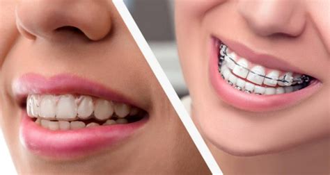 What Is Invisaligns Smart Advantage Alborzi Orthodontics