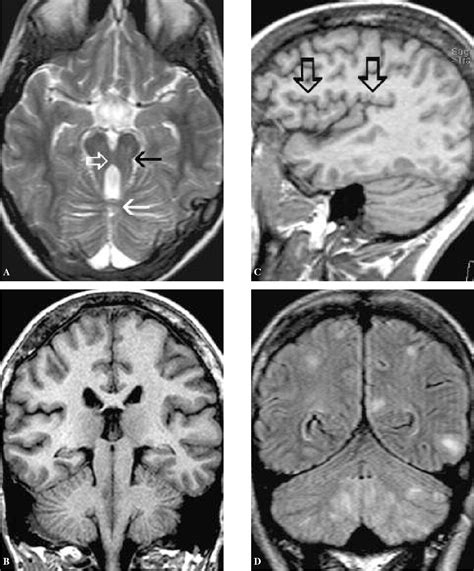 Figure 1 From Joubert Syndrome Associated With New Mri Findings And