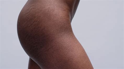 Stretch marks on the calves can be seen in the individuals who have experienced weight fluctuation or rapid growth spurts, including pregnant women and adolescents. Stretch Marks: How to Minimize Appearance - Allure