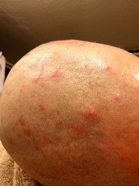 What Are These On My Scalp They Hurt At Iodine Supplementation