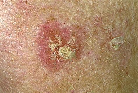 He struggled for five years and then died. let me be clear—this is not helpful. Skin Cancer on Scalp Pictures - 20 Photos & Images ...