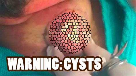 What Is The Difference Between A Cyst And A Pimple YouTube