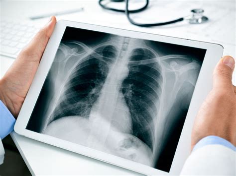 Chest X Ray Purpose Procedure And Risks