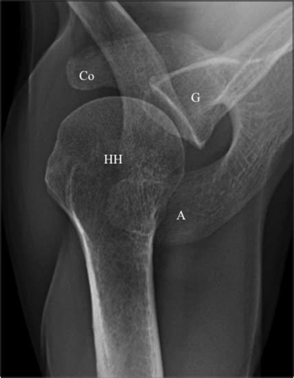 Shoulder X Ray Basicmedical Key