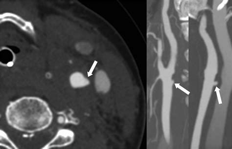 Interpretation Errors In Ct Angiography Of The Head And Neck And The