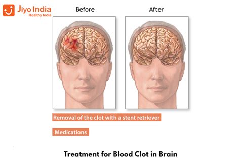 Blood Clot In Brain Causes Symptoms Treatment And Lot More