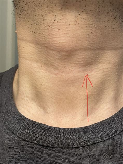 Small Bump Under Adams Apple Is This A Thyroid Issue Rthyroidhealth