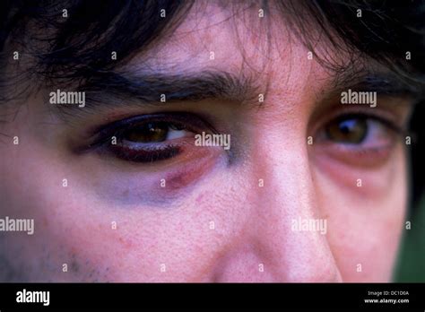 Man With Black Eye Stock Photo Alamy