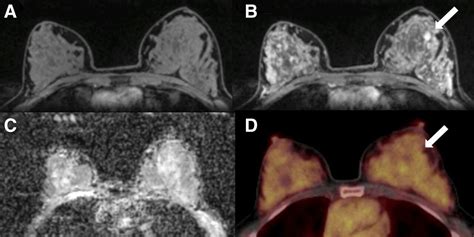 Petmri Identifies Notable Breast Cancer Imaging Biomarkers