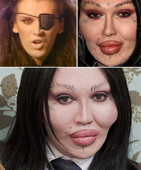 Plastic Surgery Fails 8 Lip Enhancements Gone Wrong Oddee