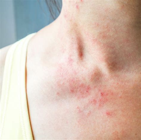 These Pictures Will Help You Identify The Most Common Skin Rashes Artofit