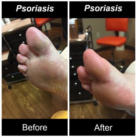 Psoriasis Often Confused With Athletes Foot Sole Purpose Foot Care