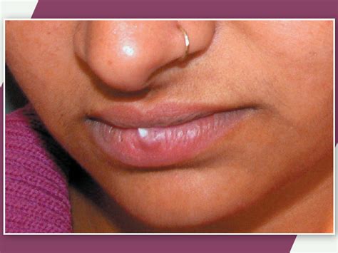 Causes Symptoms And Treatment Of White Bumps Or Fordyce Spots On Lips