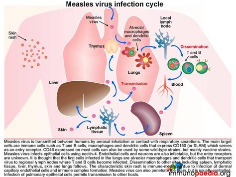 Subacute Measles Encephalitis Case Study Immunopaedia