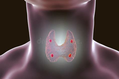 Parathyroid Glands Anatomy Stock Illustration Illustration Of