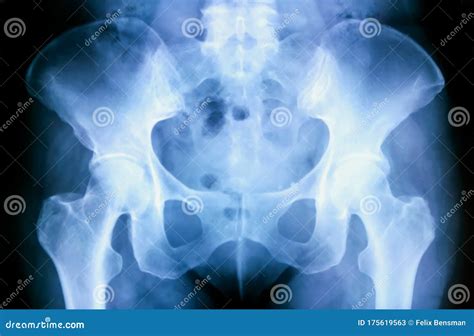 Pelvic Bone Anatomy Xray