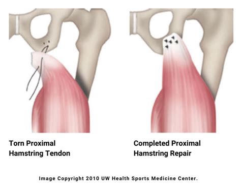 proximal hamstring tendon rupture