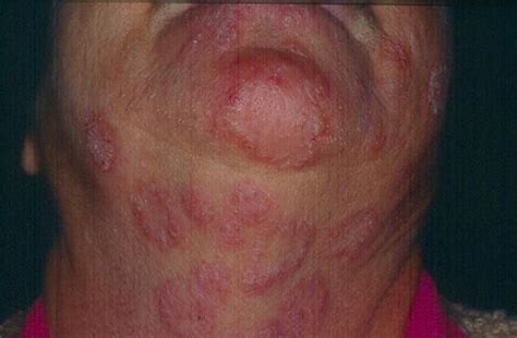 Superficial Fungal Infections Tinea Faciale Picture Hellenic