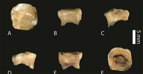 In A Lost Baby Tooth Scientists Find Ancient Denisovan Dna The New