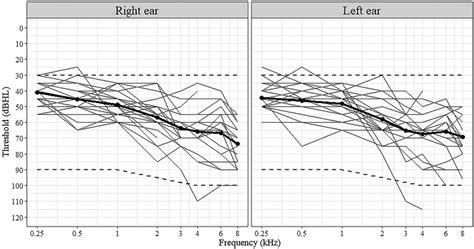 Audiograms For The Right And Left Ears Of Participants Thin Lines