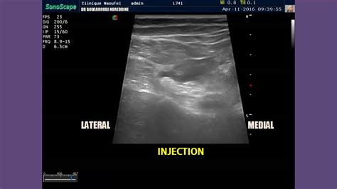 Ultrasound Guided Popliteal Sciatic Nerve Block And Sonoanatomy Of The