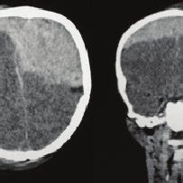 Axial And Coronal Ct Scan Images Showing Vertex Epidural Haematoma In Download Scientific