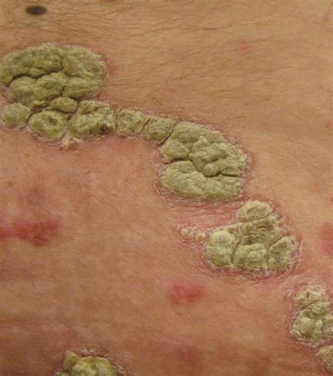 Psoriasis Comment Reconnaitre Et Soigner Cette Maladie De La Peau