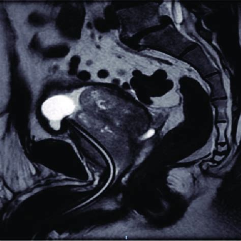 T2 Weighted Prostate Mri In Sagittal View Showing A Diffusely Enlarged