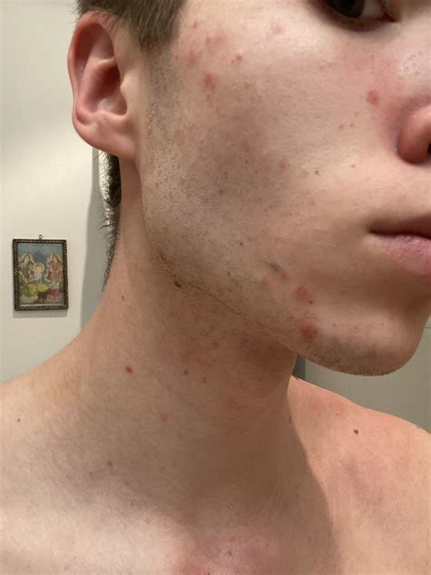 Skin Concerns Really Sensitive Dry Red And Itchy Skin Desperately