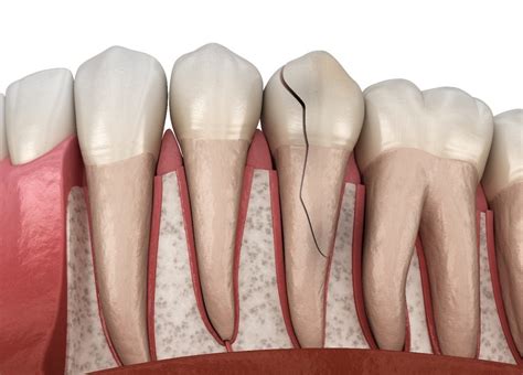 Do You Have A Cracked Tooth 5 Signs To Watch For