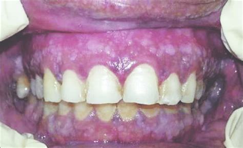 Multiple Papules On Gingiva Giving Rise To A Cobblestone Appearance
