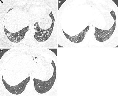 Ct Of Post Acute Lung Complications Of Covid 19 Radiology