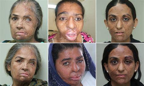 Women Scarred By Acid Attacks Have Reconstructive Surgery Daily Mail
