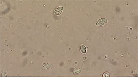 Trichomoniasis Pictures Symptoms Causes And Treatment Std Testing