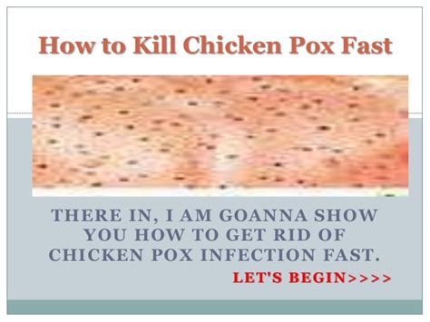 Do people get chicken pox anymore? How to Kill Chicken Pox Fast