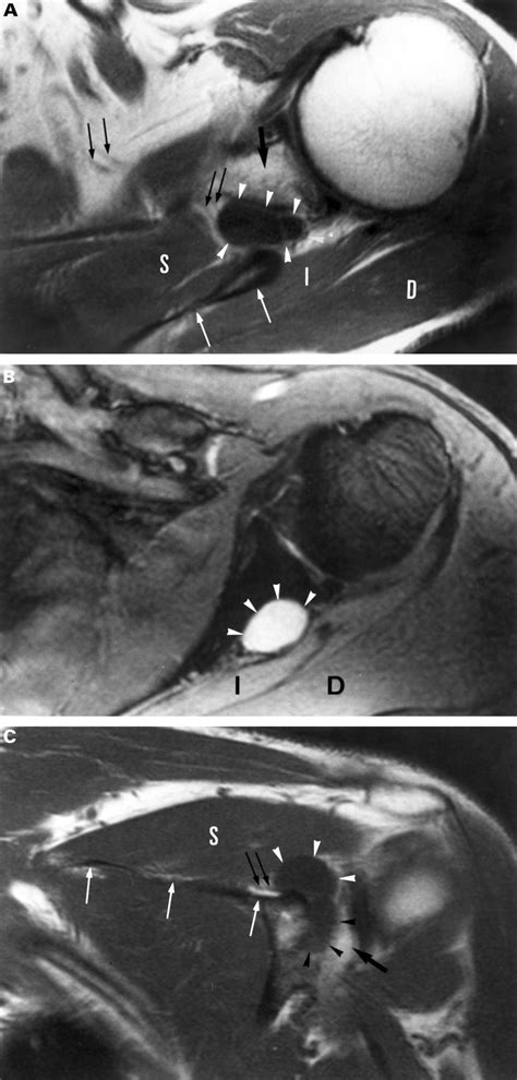 Suprascapular Nerve Entrapment At The Spinoglenoid Notch Due To A