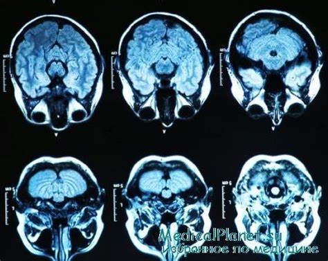 Тромбоэмболии при черепно-мозговой травме. Профилактика и лечение Картинка - Тромбоэмболии при черепно-мозговой травме. Профилактика и лечение