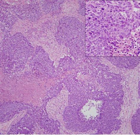 Poorly Differentiated Non Keratinizing Squamous Cell Carcinoma