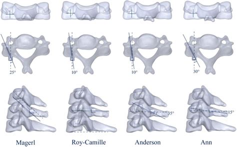 Four Lateral Mass Screw Fixation Techniques In Lower Cervical Spine