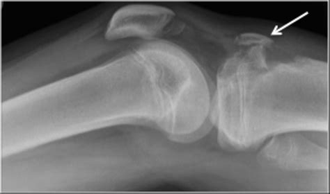 Tibial Tuberosity Lesions Clinical Radiology