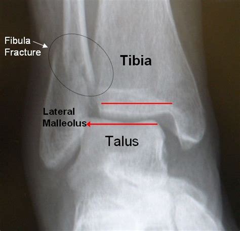 Lateral Malleolus Fracture Distal Fibula Fracture Ankle Fracture
