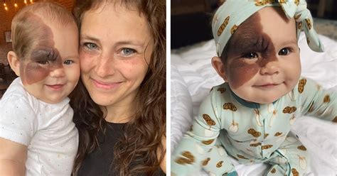 Mom On A Mission To Show Daughter With Extremely Rare Birthmark That