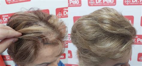 Injerto capilar mujer en Clínicas Dr. Pelo – 151 | Clínicas Dr. Pelo