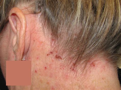 Seborrheic Dermatiti Pictures