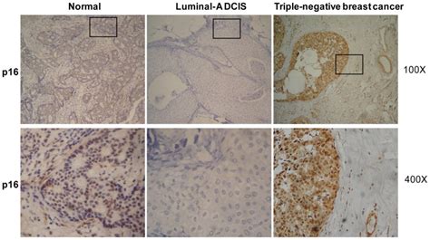 Typical Images Of P16 Ihc Staining Are Shown At Two Different