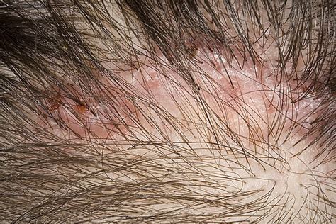 Folliculitis On Head Pictures 54 Photos And Images