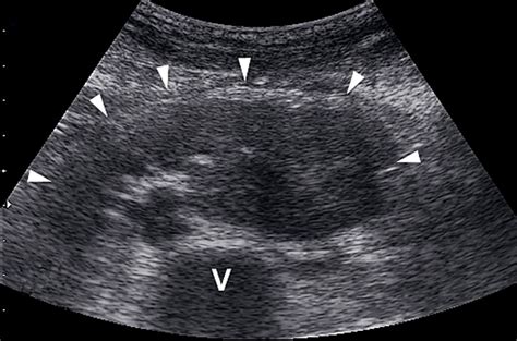 New technical renements and sequence modications promise to widen the potential of mr urography (mru) to become a comprehensive ''all in one'' imaging tool, offering not only. Renal Images | Emergency Ultrasonography